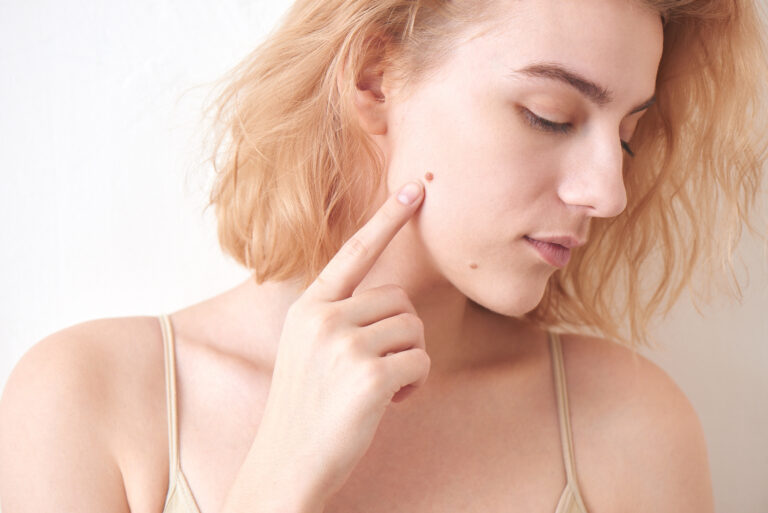 Why Do You Get Skin Moles and Beauty Marks?