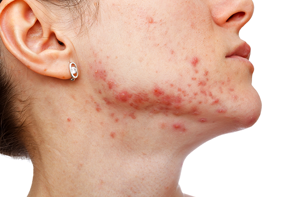 Acne Help for Adults and Teens 