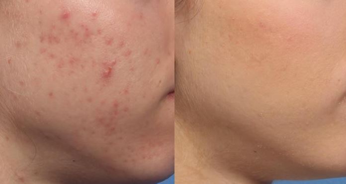 Metrin Skincare Experience: Learn how Jamilia went from acne & scarring to clear glowing skin