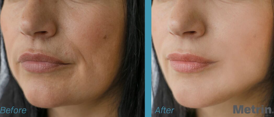 Vitamin K- Skin Care Benefits and Dark Under Eye Circles